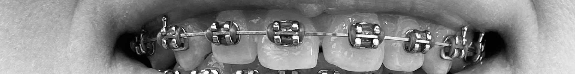 Braces